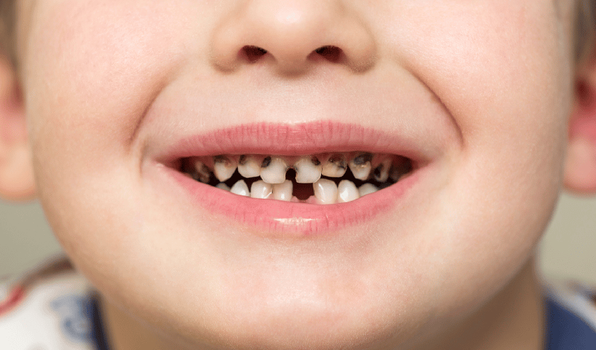 Featured image for “What Role Does Sugar Play In My Child’s Teeth and Cavities?”